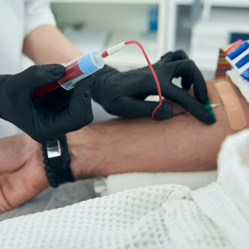 PRP inc Vampire Facial treatment